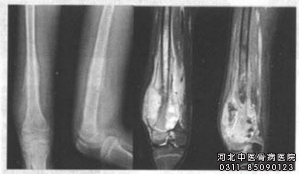 化脓性骨髓炎