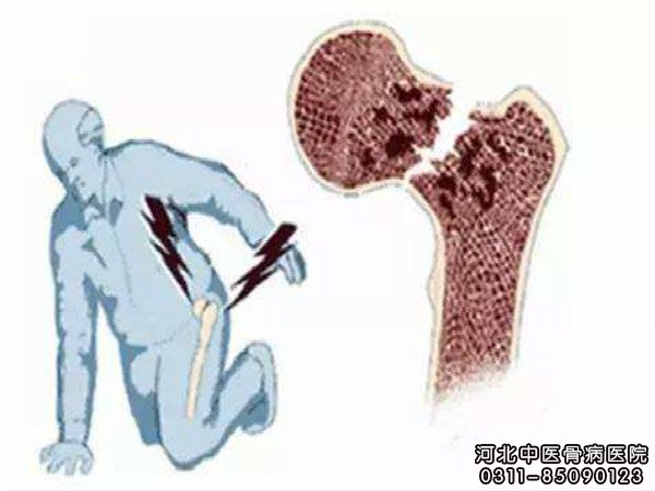 股骨头坏死