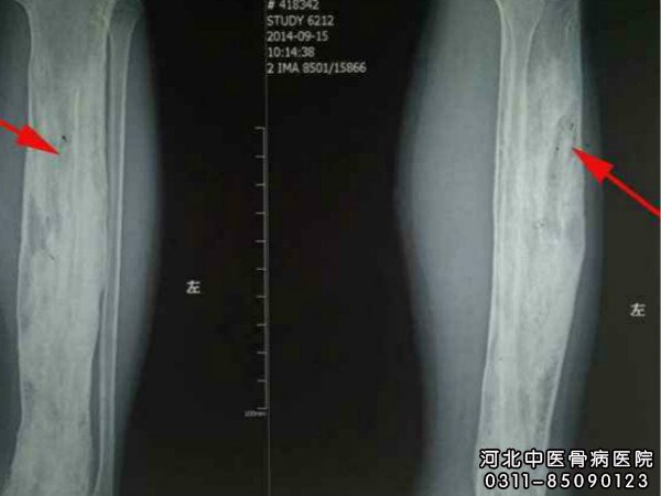 骨髓炎