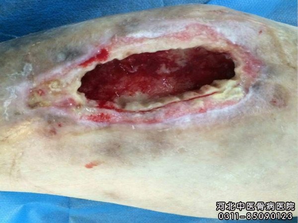 骨髓炎