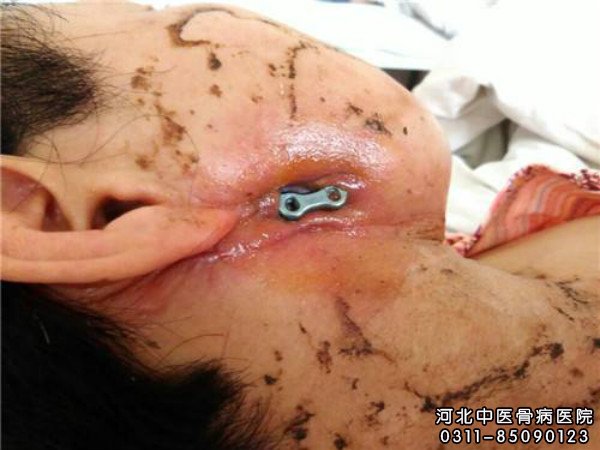 颌骨骨髓炎