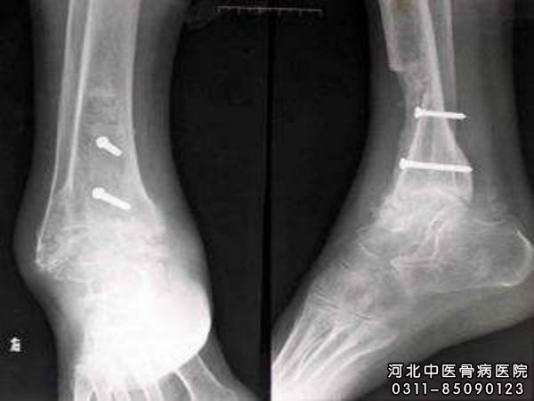 骨髓炎
