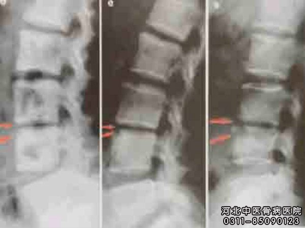 骨髓炎