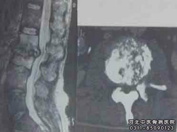骨髓炎