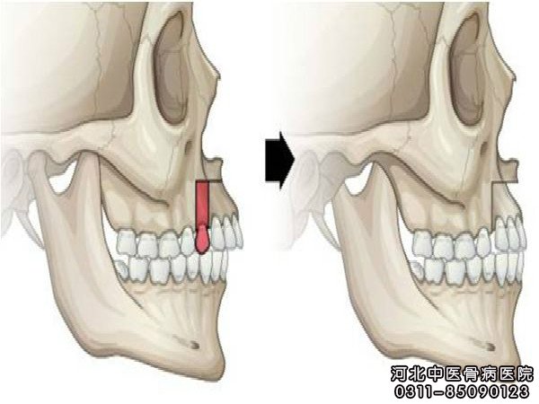 骨髓炎