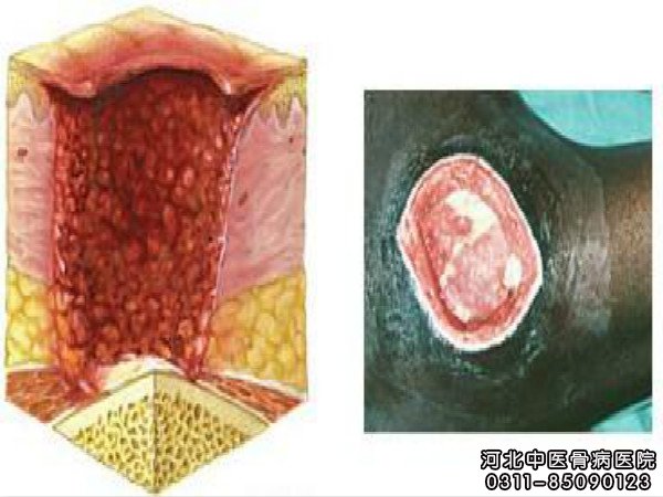 骨髓炎