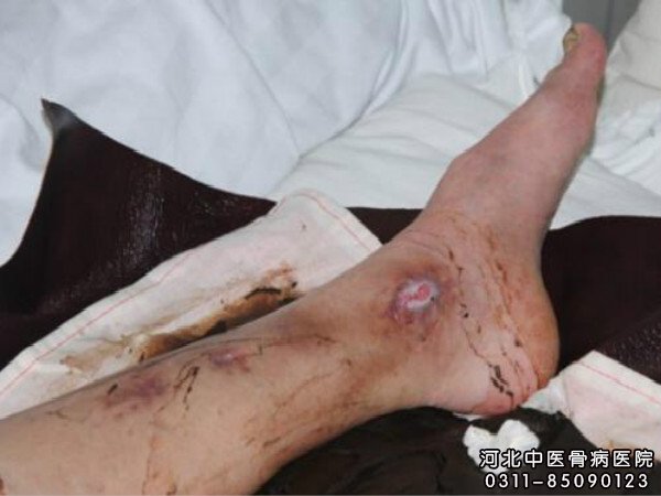 骨髓炎