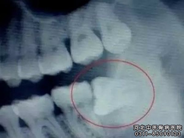 骨髓炎