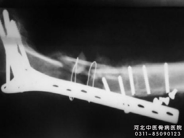 骨髓炎