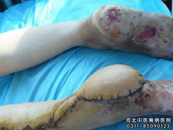 骨髓炎