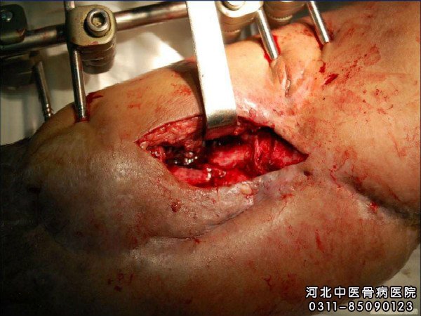 骨髓炎