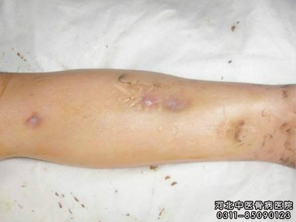 骨髓炎