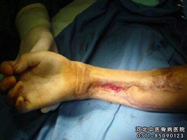 骨髓炎