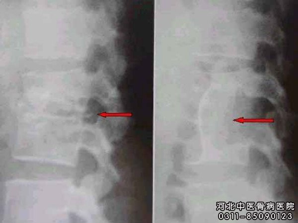 骨髓炎
