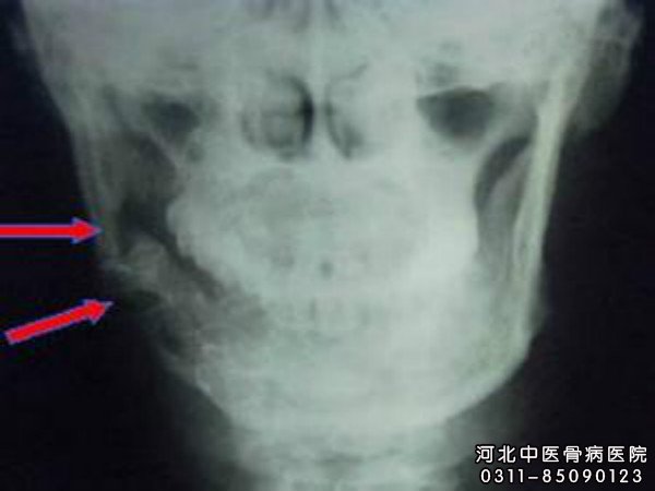 骨髓炎