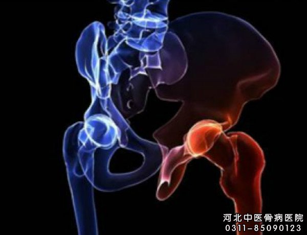 股骨头坏死