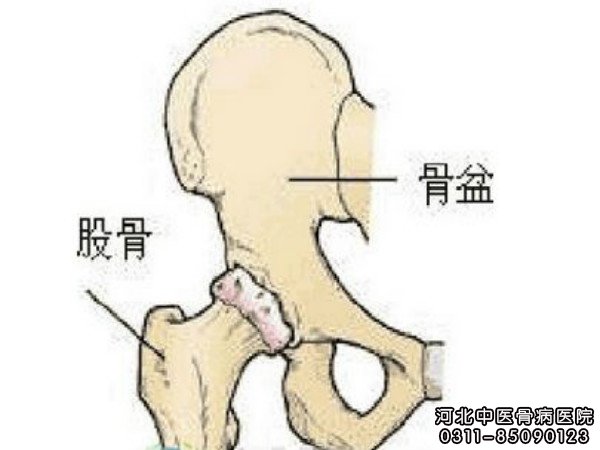 股骨头坏死