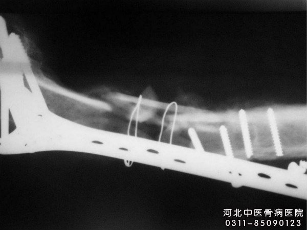 骨髓炎