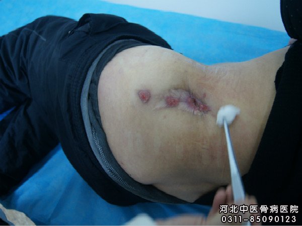 骨髓炎