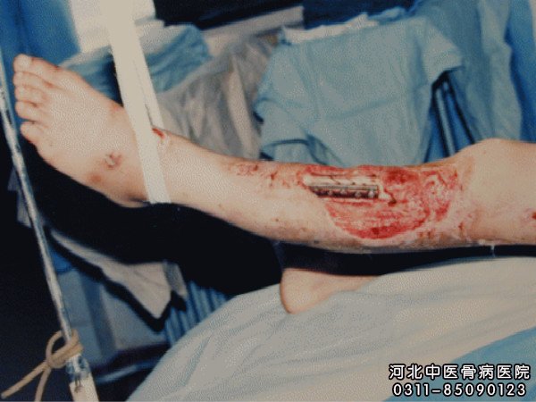 骨髓炎