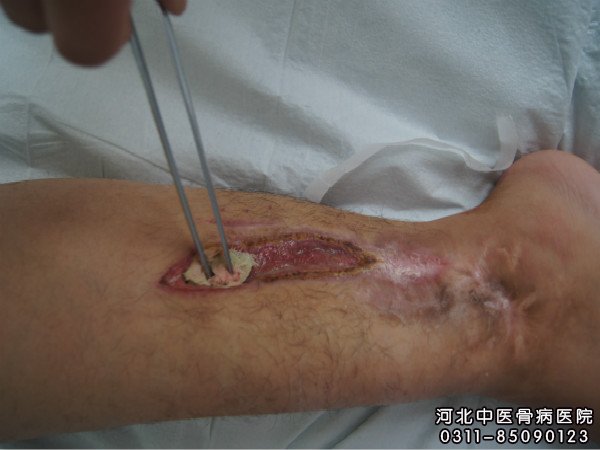 骨髓炎