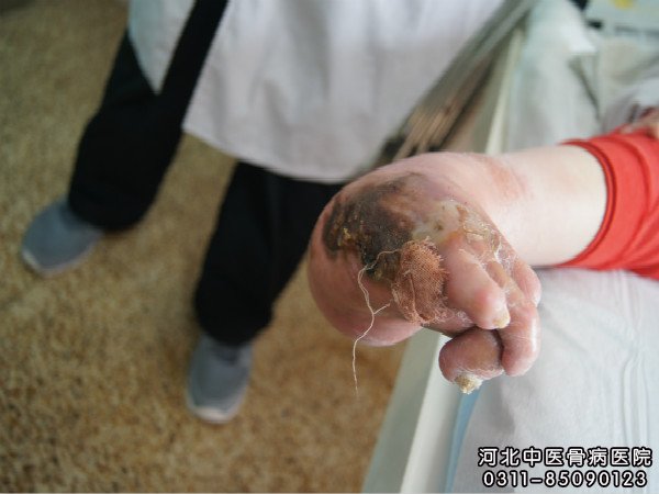 骨髓炎
