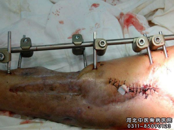 骨髓炎