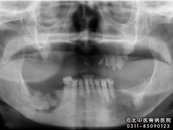 骨髓炎