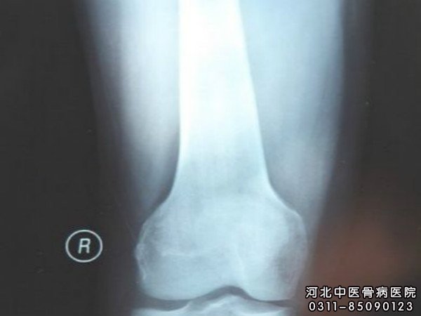 骨髓炎