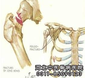 骨折