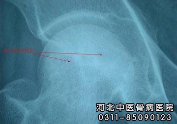 股骨头坏死