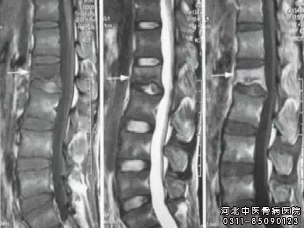 腰椎结核