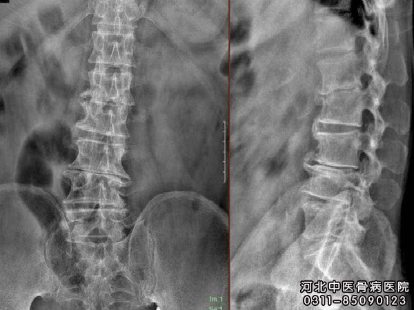 腰椎结核