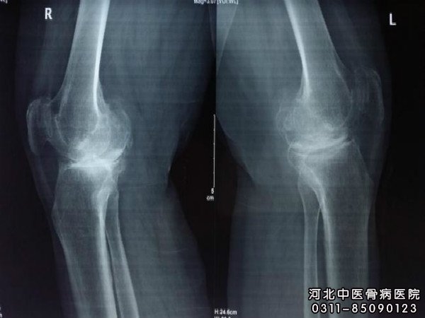 骨结核