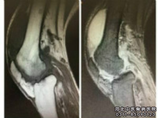 膝关节结核