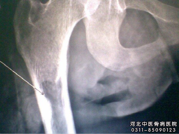 骨髓炎