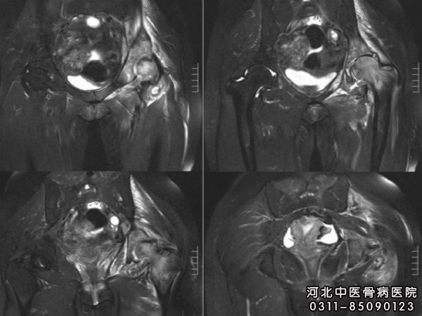 髋关节结核
