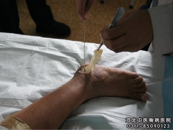 骨髓炎