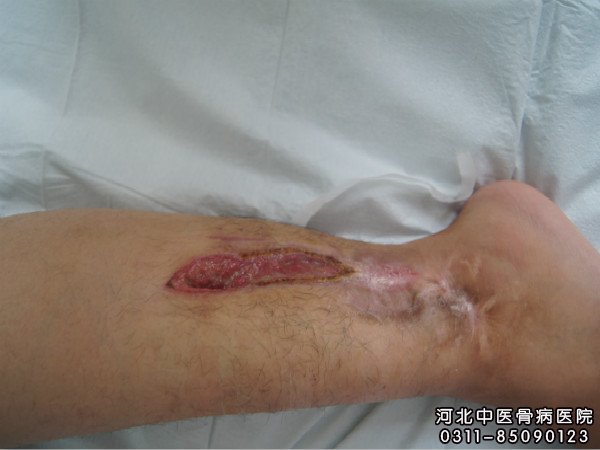 慢性骨髓炎