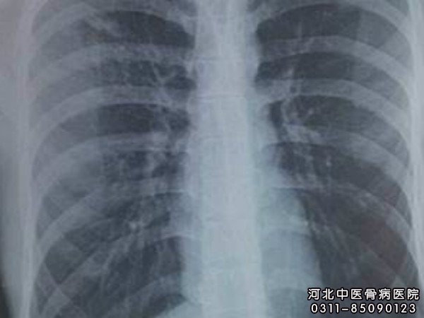 胸椎结核