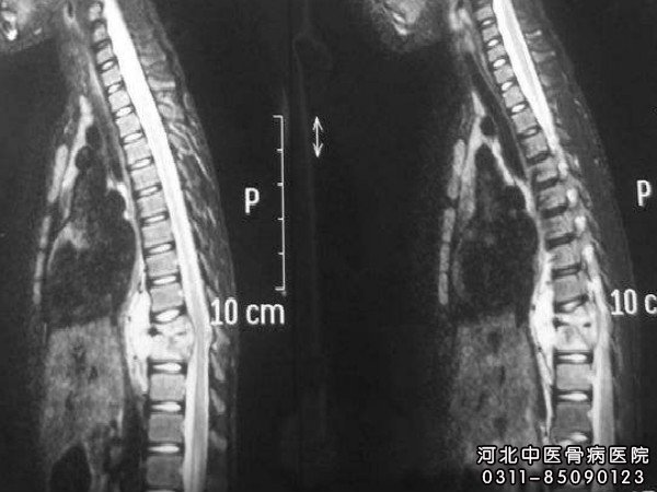 脊柱结核