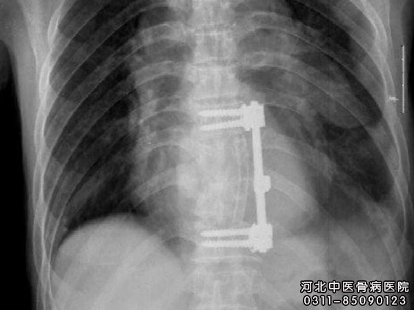 胸椎结核