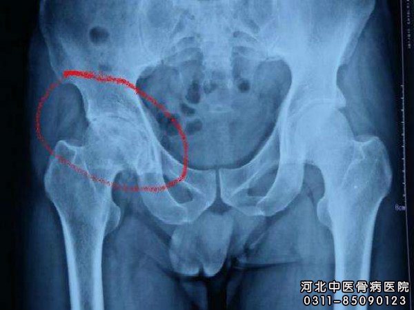 股骨头坏死