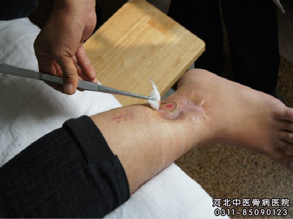 骨髓炎