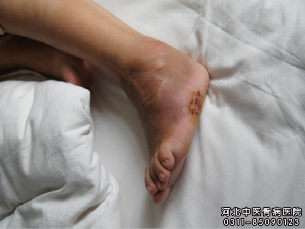 伤口不愈合