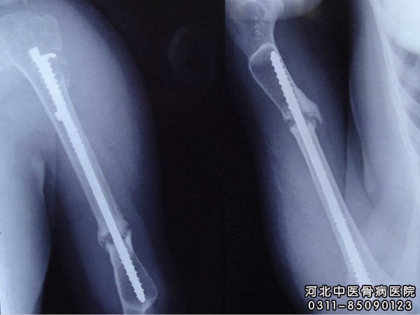 骨不连