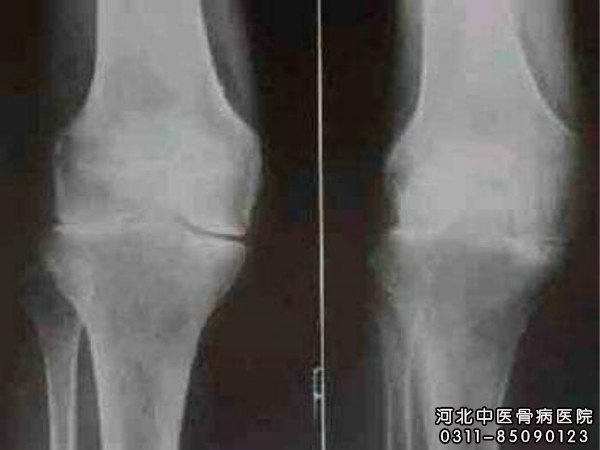 骨结核