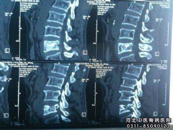 骨结核