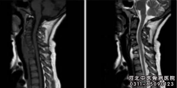 骨结核