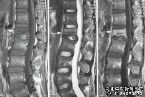 骨结核